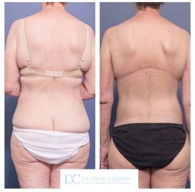 Belt Lipectomy, Back Bra and Thigh Lift - The Lotus Institute