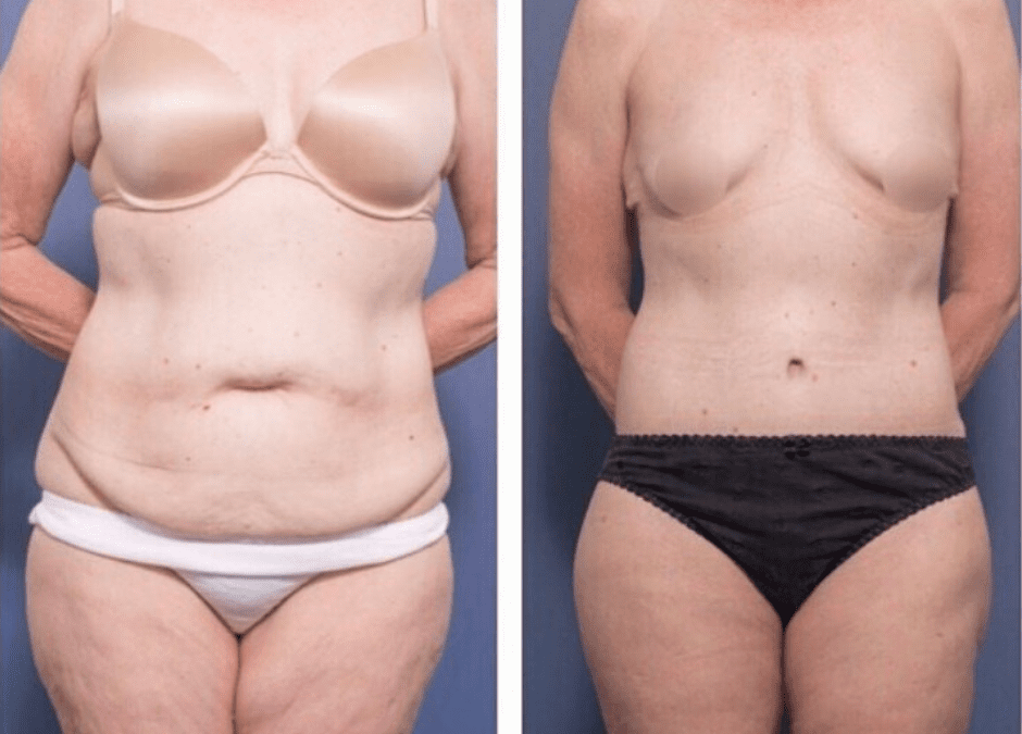 Back Lift Lipectomy Surgery Sydney - Post Weight Loss Surgery