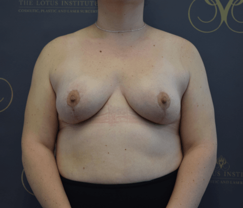 Patient 24: After w/ Mastopexy