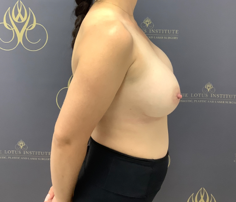 After: Changeover of Implants & Capsulectomy