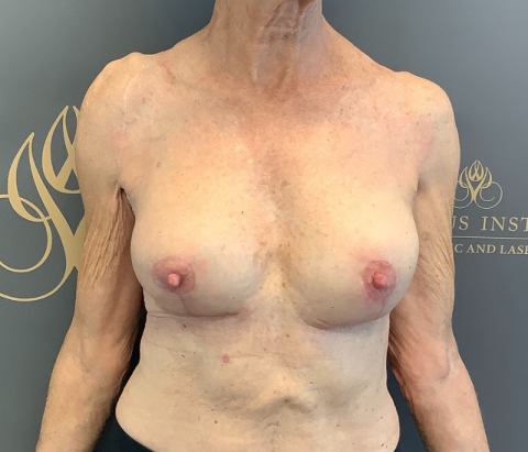After: Changeover of Implants & Mastopexy