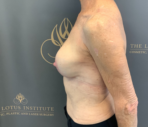 After: Changeover of Implants & Mastopexy