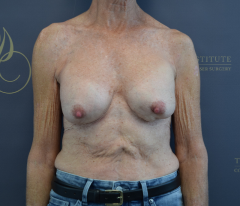 Before: Changeover of Implants & Mastopexy