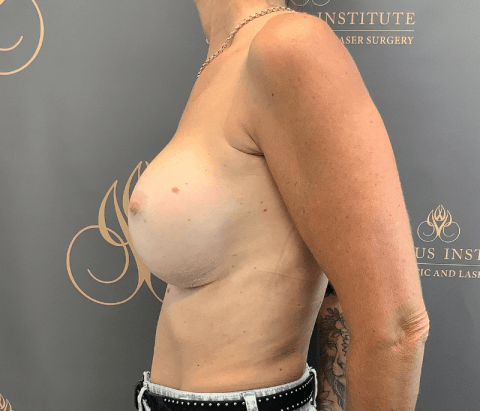 After: Capsulectomy & Changeover of Implants