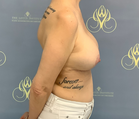 After: Capsulectomy & Changeover of Implants
